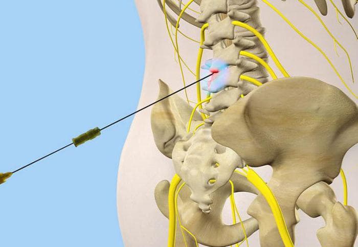 Процедура епідуральної блокади