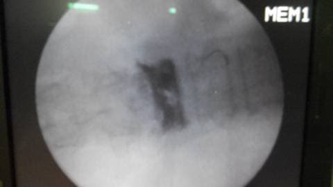 Состояние после удаления баллонов и введения цемента