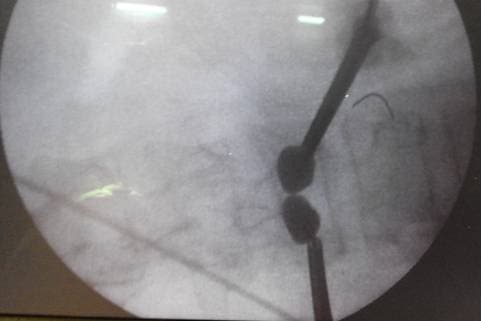 Баллоны в теле позвонка в раскрытом состоянии