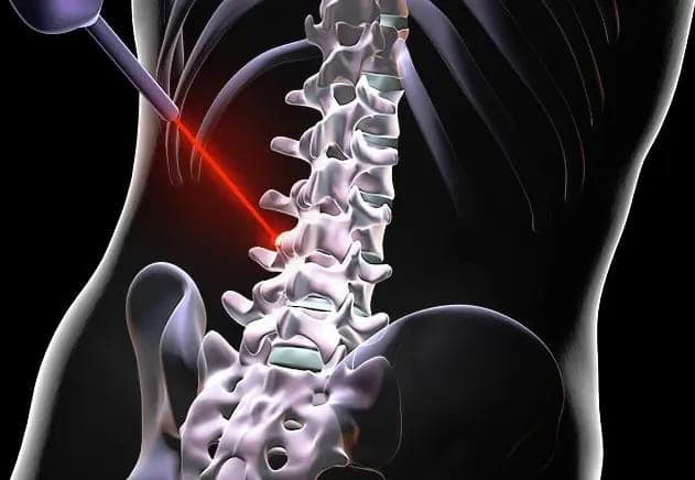 Лазерна процедура