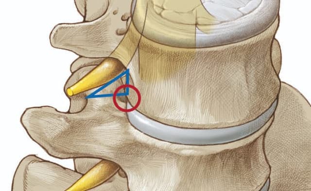 Трикутна зона за Парвіз Камбін і робоча зона для доступу TESSYS™