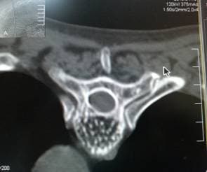 Гемангиома тела позвонка (пчелиные соты)
